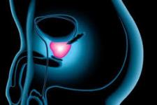 Ipertrofia e iperplasia PROSTATICA